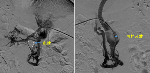 血栓攔路，如何破局——罕見巨大門靜脈血栓TIPS手術(shù)實(shí)錄