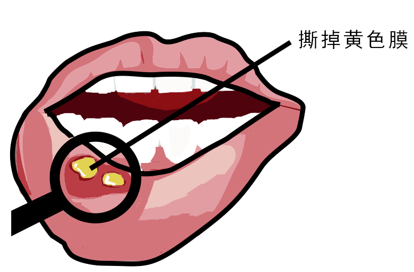 經(jīng)?？谇粷?，真的只是缺維生素嗎？