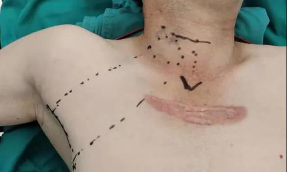 術(shù)后傷口可以“隱身”嗎？