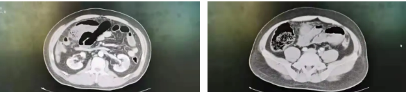 腹部疼痛難忍 醫(yī)生急診手術挽救生命