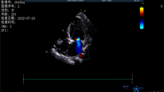 心電圖異常，心臟卻沒事，罪魁禍首是……