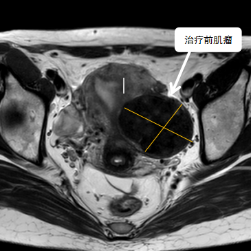 保子宮、保留生育功能—磁波刀治療子宮肌瘤